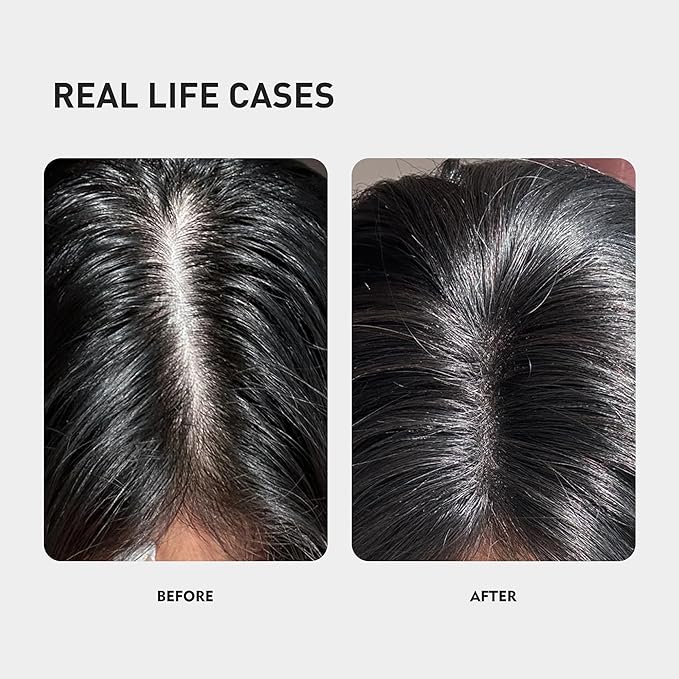 0.5% KINTOR KX-826 Hair Growth Spray,Oil Control Strengthen Hair,Hair Regrowth Products for Women&Men,Basic,180ml