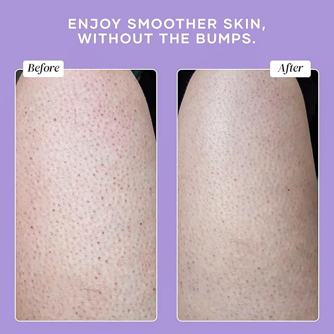 DERMAdoctor KP Bump Eraser Body Scrub with 10% AHAs + PHAs for Keratosis Pilaris, Dry, Rough, and Bumpy Skin, Dermatologist Formulated Exfoliating Body Scrub with Glycolic and Lactic acids - 8 Fl oz