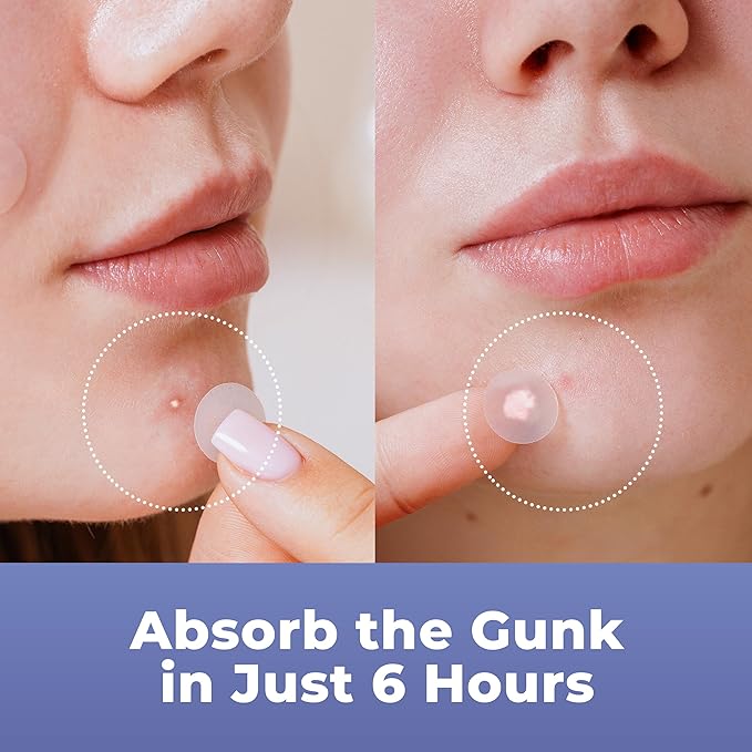 Pimple Patches for Face (240 Patches), Hydrocolloid Acne Patches with Tea Tree Oil & Salicylic Acid, Pimple Patch Pimple Stickers, Hydrocolloid Patch Acne Dots Acne Pimple Patches For Face