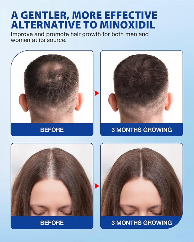Hair Growth Serum Roll On 30ml – 3% Rosemary, 3% Redensyl，2% Anagain, Niacinamide & Tocopherol | Reduces Hair Loss at the Root for Men & Women | No-Rinse, Non-Greasy, Fast-Absorbing
