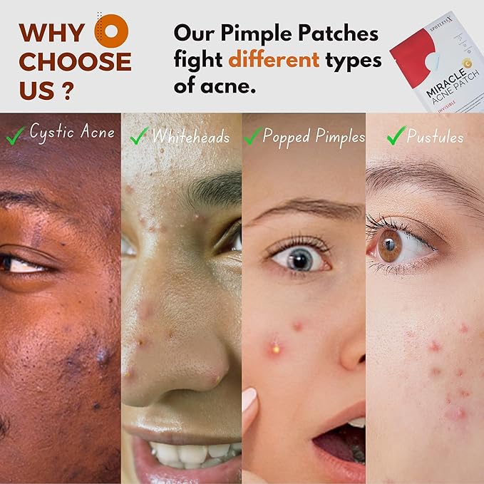 Overnight Hydrocolloid Miracle Patch, Invisible Pimple Patches Zit Stickers for Face & Body, Fast-Acting Acne Treatment with Salicylic Acid & Tea Tree Oil, Waterproof, Hypoallergenic, 96 Pcs, 3 Sizes.