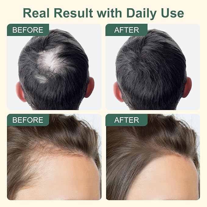5% Minoxidil Hair Growth for Men and Women, Extra Strength Minoxidil Hair Loss Treatment Serum with Biotin & Herbal Extracts for Faster Thicker Stronger Hair Growth 60mL