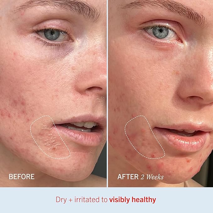 First Aid Beauty Ultra Repair Cream Intense Hydration Moisturiser for Face and Body – Rich Whipped Texture For Immediate Skin Hydration, 170.1g