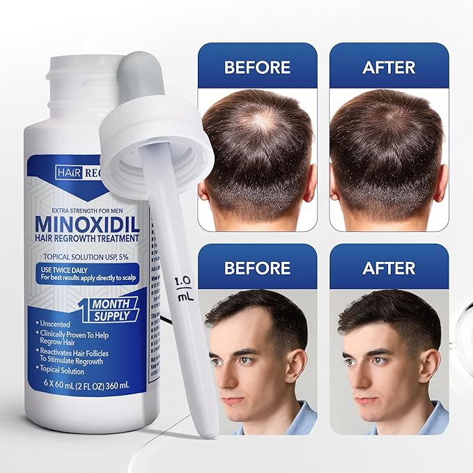 Liquid Minoxidil Men 5% Percent - Extra Strength Advanced Topical Solution for Regrowth Serum Drops - Clinically Proven Growth Treatment for Hims Hair Loss 1 Pack as 1 Month Supply Kit