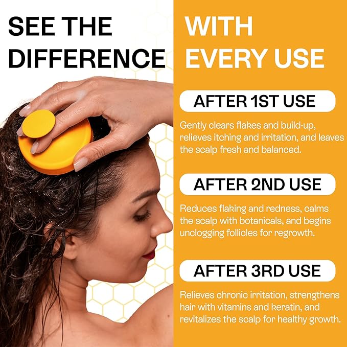 Psoriasis Shampoo for Dry & Itchy Scalp - Psoriasis Scalp Treatment for Eczema Relief, Seborrheic Dermatitis, Ringworm & Folliculitis - Itchy Scalp Shampoo for Flakes & Acne with Manuka Honey