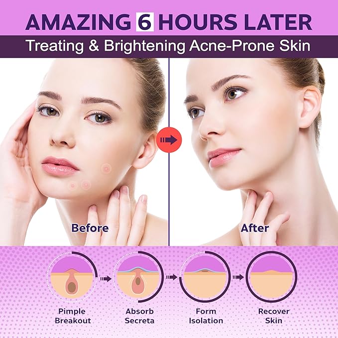 FSA HSA Acne Treatment | Anti-Bacterial Pimple Patches | Fast Acne Drying Treatment | Dual Action Acne Patch | Hydrocolloid Spot Cover | Zit Stickers | Korean Healing Dots | Soothing | 72 Counts |