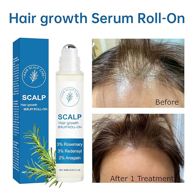 Rosemary Hair Growth Serum Roll On, 3% Rosemary 3% RedensyI & 2% Anagaln Hair Beard Growth Serum, Thicker Stronger Hair Beard, Prevents Hair Fall Stimulates Hair Follicles for All Hair Types - 25ml