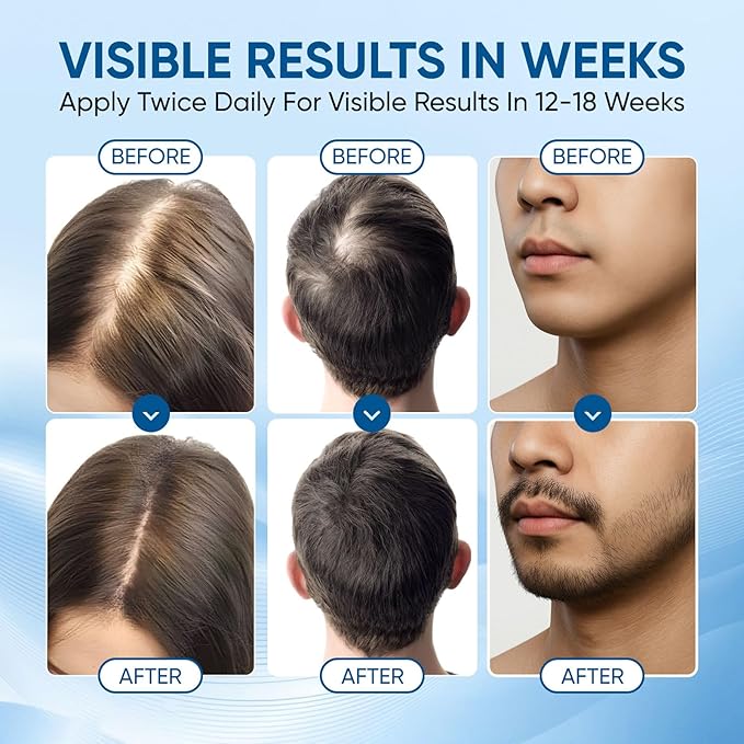 Rosemary Scalpy Hair Growth Serum Roll On, Orrenaturals Hair Revival Ampoule, Hair Regrowth Roller for Fuller, Thicker, Stronger Hair, Repair Hairline & Thinning Hair for Men & Women (2 Pack)